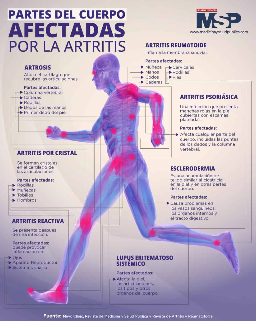 partes-del-cuerpo-afectadas-por-la-artritis-2828e151